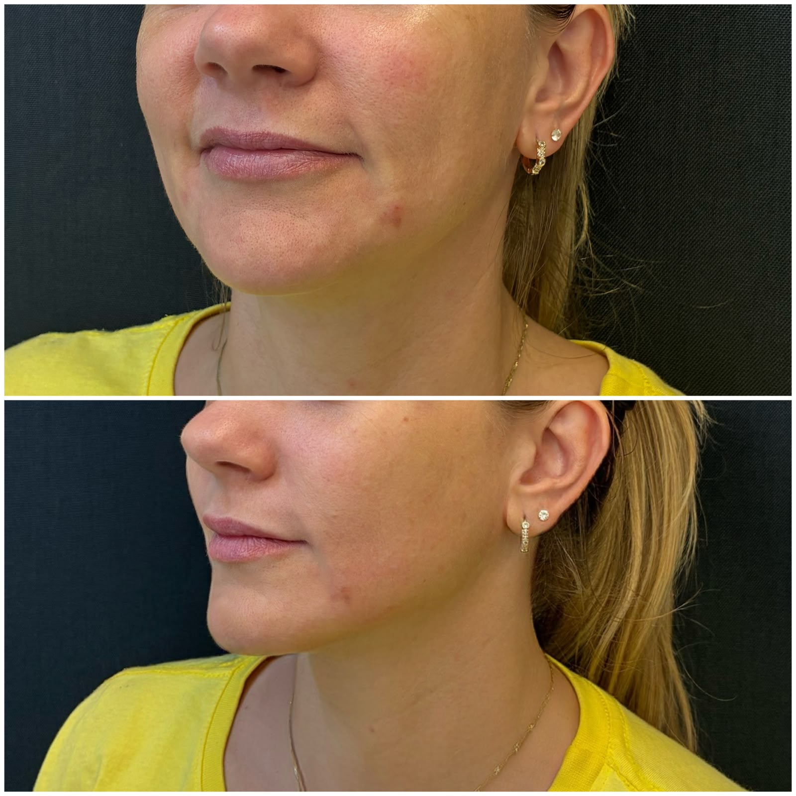Registro real de antes e depois facial 3