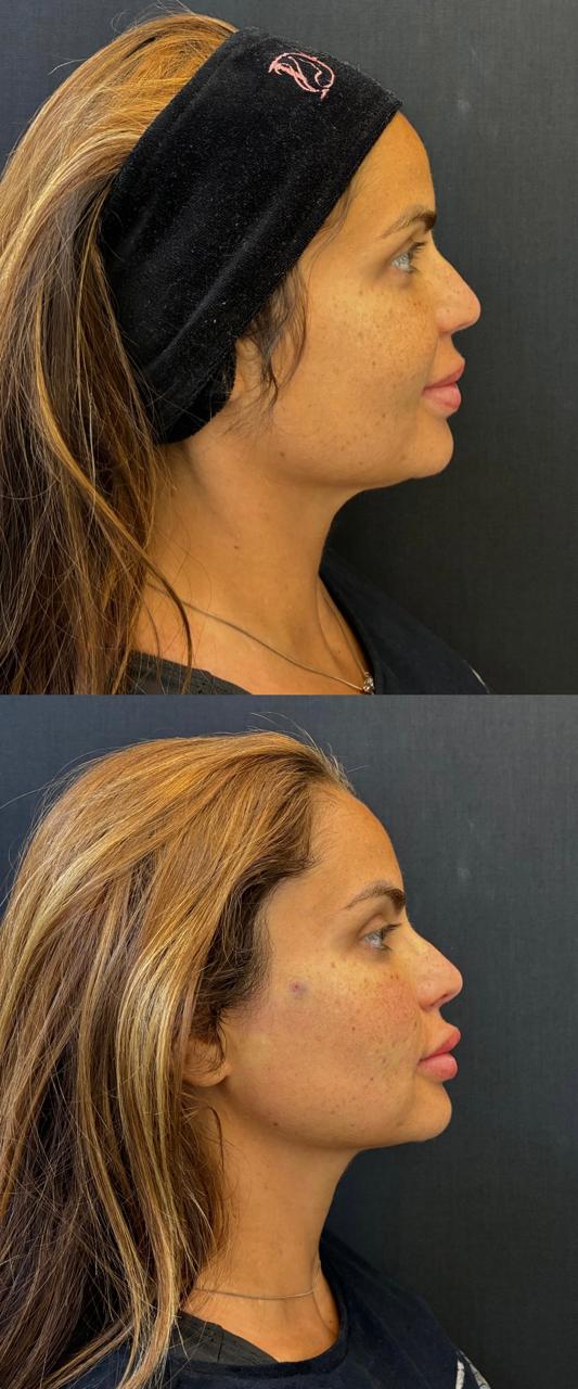 Registro real de antes e depois facial 4