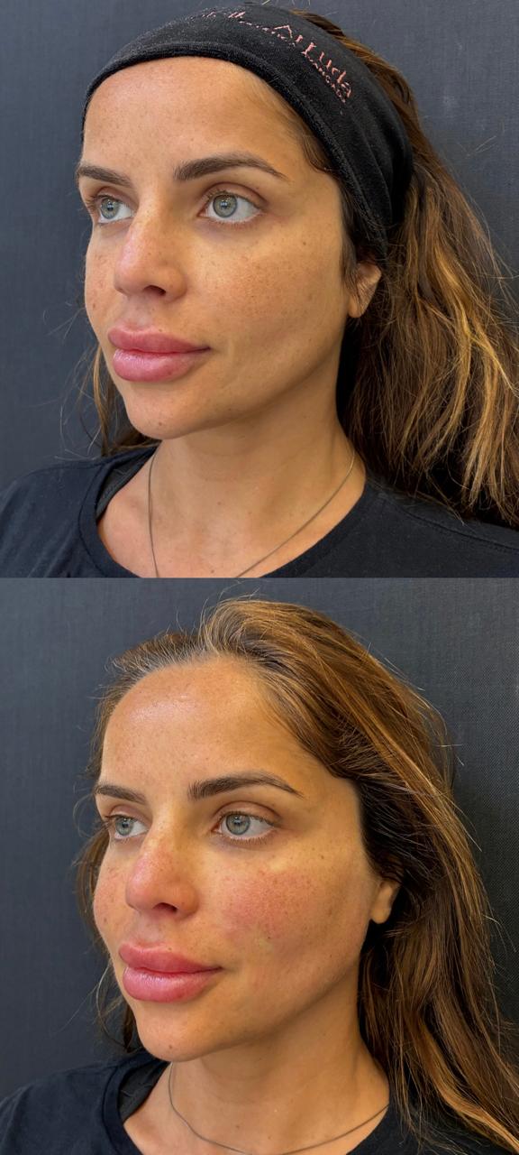 Registro real de antes e depois facial 5
