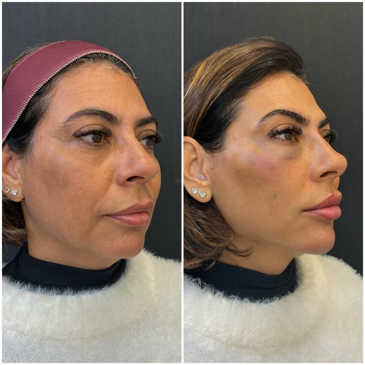 Registro real de antes e depois facial 10