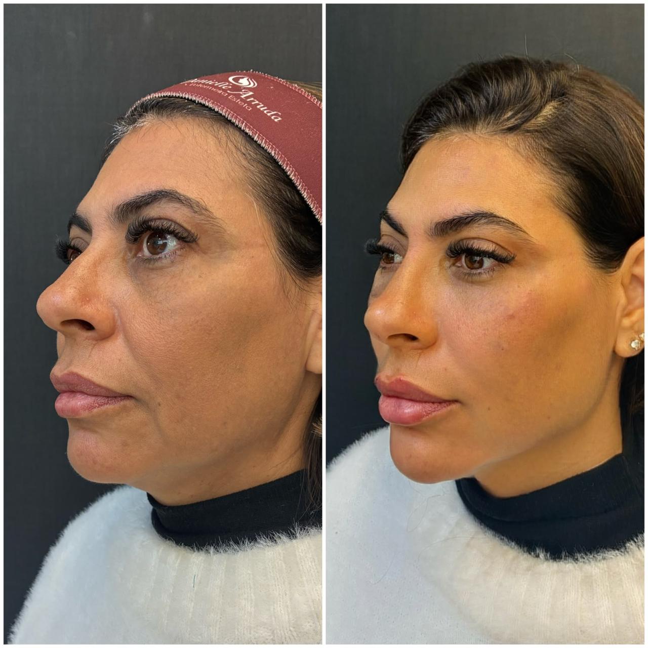 Registro real de antes e depois de harmonização facial