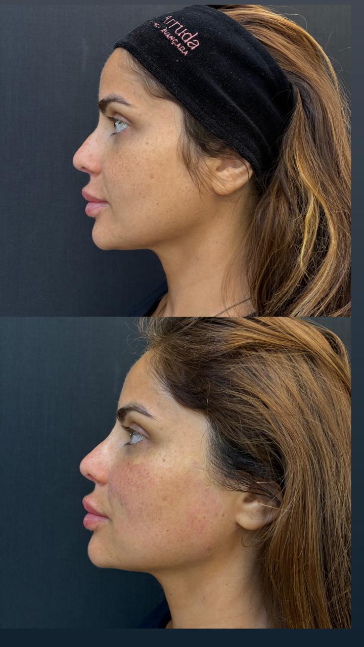 Registro real de antes e depois facial 6
